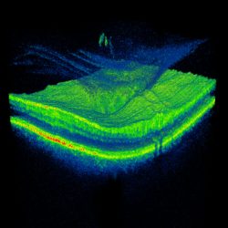 Scan detecting a PVD that has produced a small floater