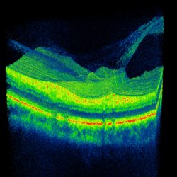 Scan of PVD that has resulted in the posterior vitreous surface mostly peeling away from the retina. Once fully detached, the tissue should return to a flatter position