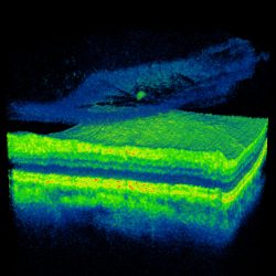 Scan after a PVD observing the posterior vitreous face to be completely detached from the retinal surface, reducing the risk of a retinal detachment
